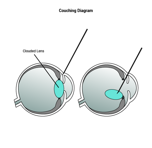 Diagram of couching 	