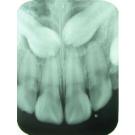 X-ray of teeth